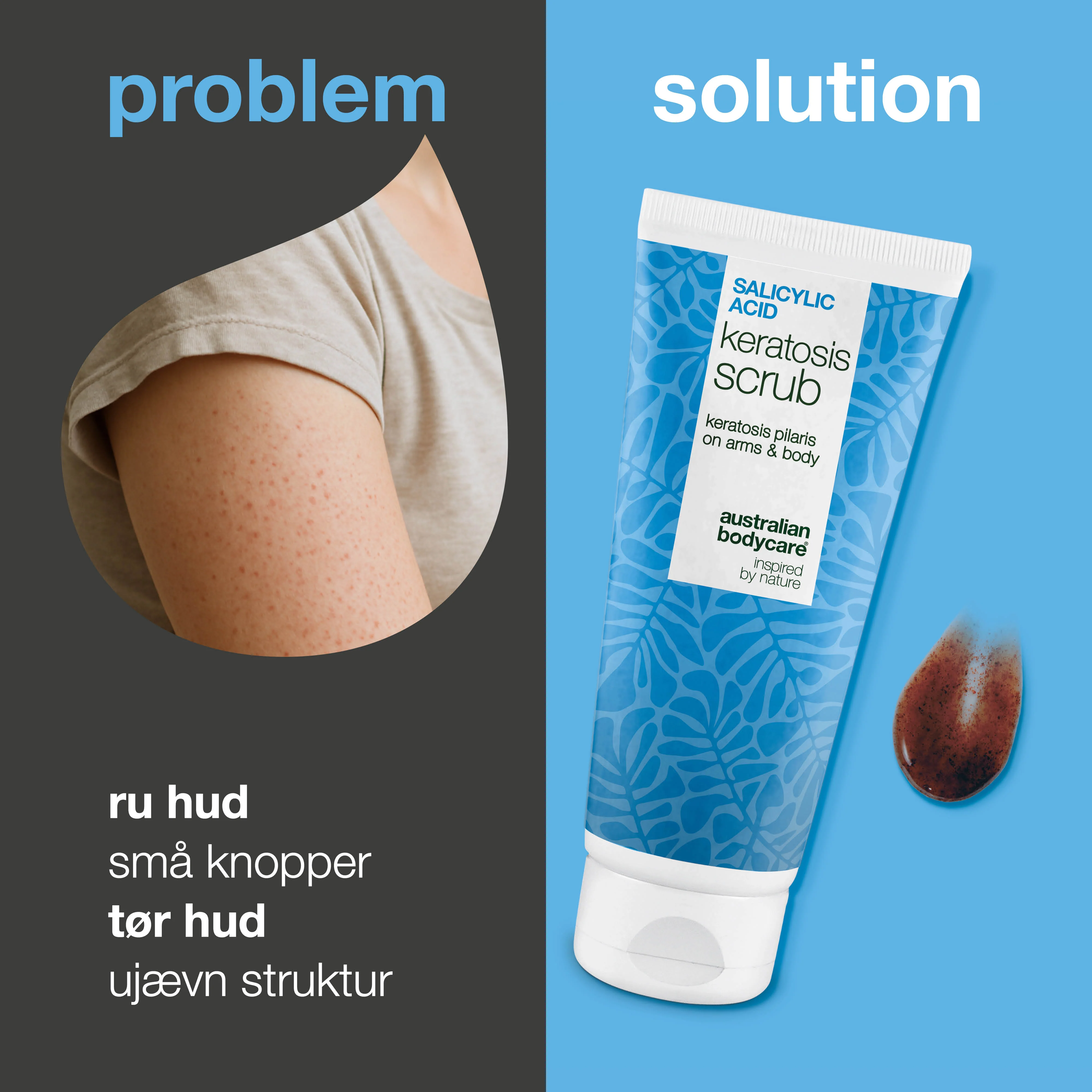 Keratosis Pilaris Body Scrub mod ru hud og knopper — Keratosis Pilaris Body Scrub mod ru hud og knopper. Eksfolierer og blødgør med salicylsyre, glykolsyre og glycerin. - Image 2
