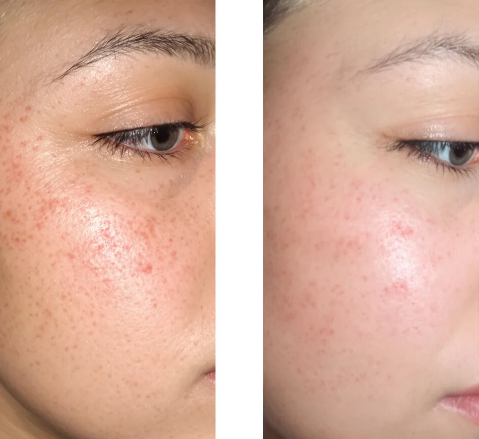Serum mod bumser, hudorme og uren hud – Salicylsyre 2 % — Serum mod bumser og fedtet hud. Renser porer og dæmper udbrud. Med salicylsyre 2 %, Zinc PCA, grøn te og hyaluronsyre. - Image 6