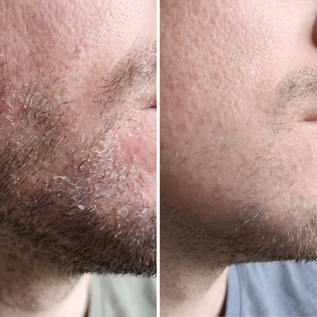 Salicylsyre serum til skæl og flager i ansigt og skæg — Serum til skæl i ansigtet, skæg, øre og øjenbryn. Salicylsyre fjerner flager og rødme hurtigt, så huden igen kommer i sund balance. - Image 8
