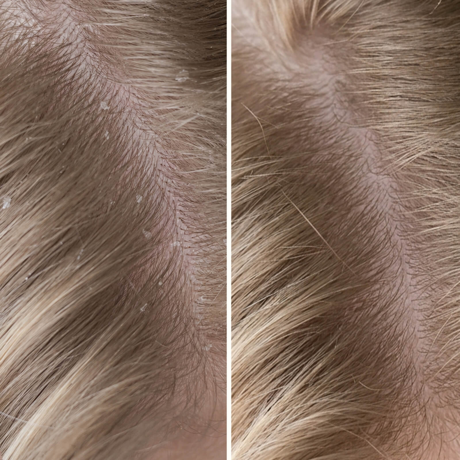Salicylsyre Shampoo mod skæl, kløe og tør hovedbund — Shampoo mod skæl, kløe og tør hovedbund. Lindrer rødme og fjerner flager samt døde hudceller effektivt med eksfolierende salicylsyre. - Image 7